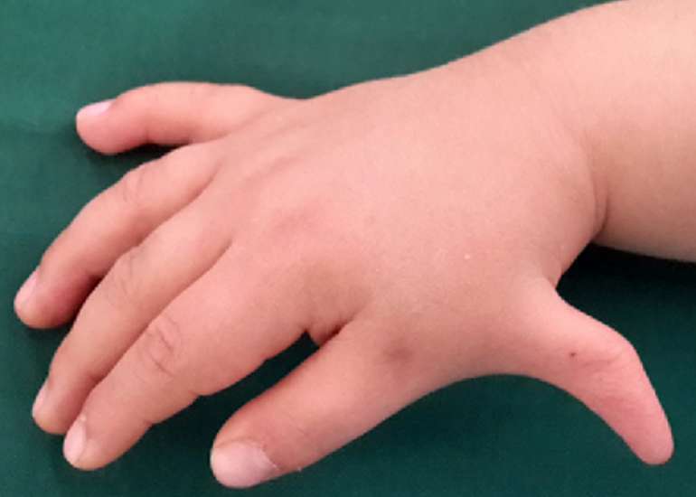 फैंकोनी एनीमिया क्या है? कारण, लक्षण और इलाज | Fanconi Anemia in Hindi