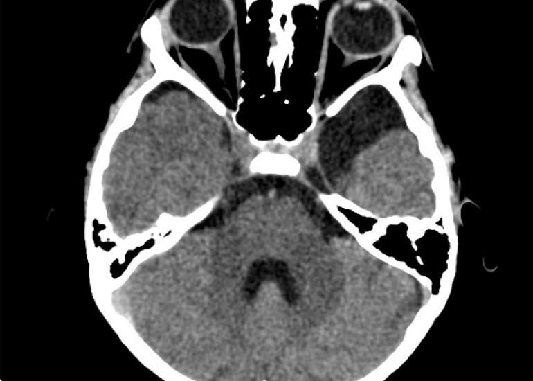 अमाइलॉइडोसिस क्या है? कारण, लक्षण और इलाज | Amyloidosis in Hindi