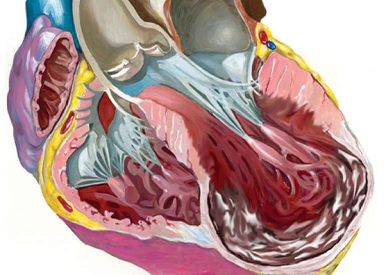 What about bypass surgery with LV volume reduction?