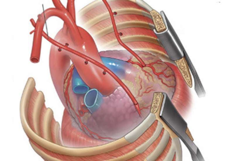 When should we go in for a total arterial bypass surgery?
