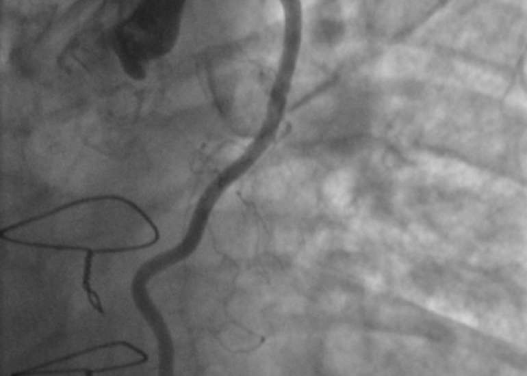 When is bypass done along with angiography?