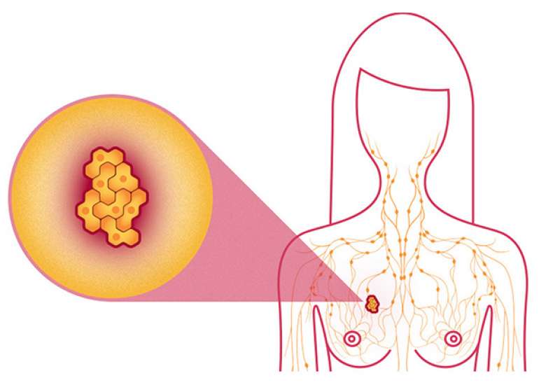 What is the survival rate for breast cancer in different  stage?