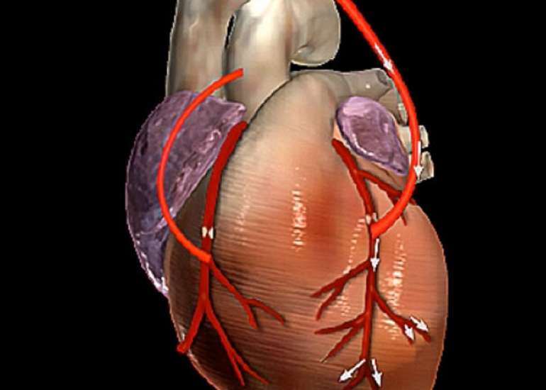  How long does bypass surgery last?