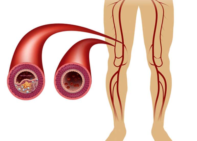 Can bypass be done along with peripheral artery intervention?