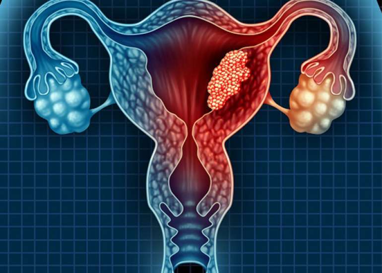 5 year survival rate in cervical cancer