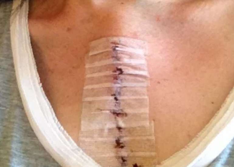 After bypass, when can a person enjoy his married life?