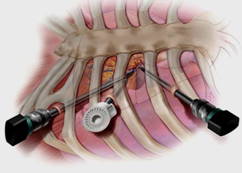 What is Minimal Invasive Heart Bypass Surgery treatment?