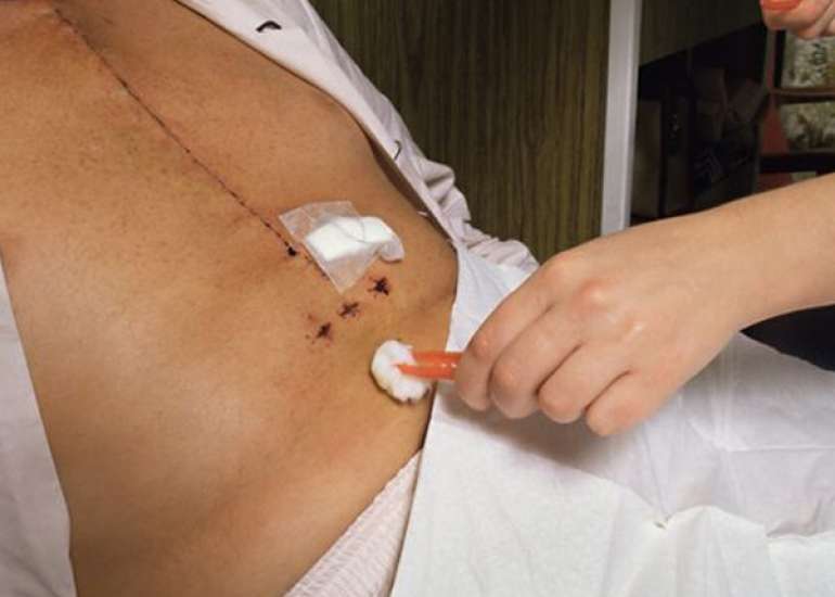 How complicated  is Coronary Heart bypass surgery?