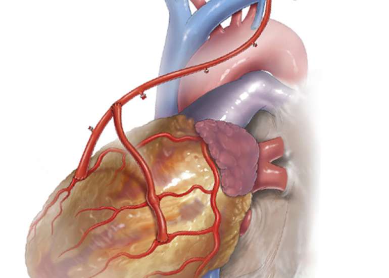 What is total arterial bypass surgery?