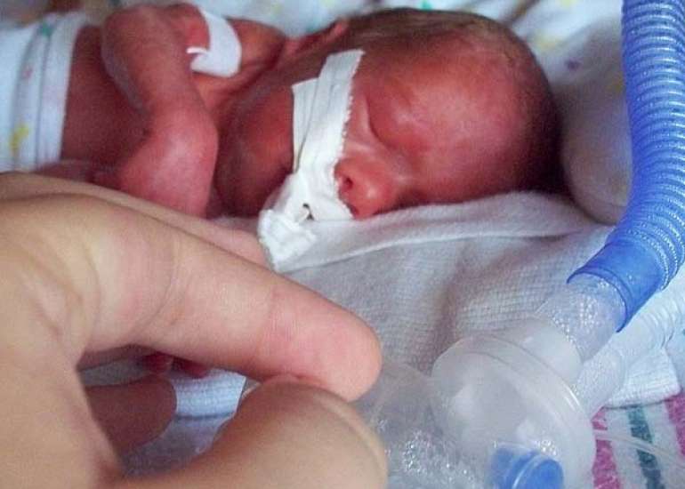 Fetal Growth Restriction does not Predispose Preterm Neonates to MBD