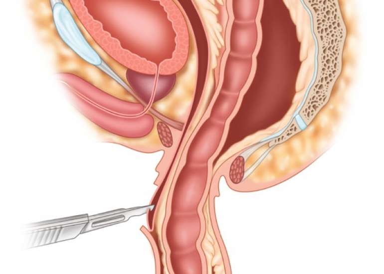 रेक्टल प्रोलैप्स क्या है? लक्षण, कारण, और इलाज | Rectal Prolapse in Hindi