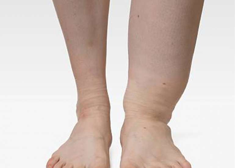 फाइलेरिया क्या है? – कारण, लक्षण, निदान, उपचार और आहार | Filariasis in Hindi