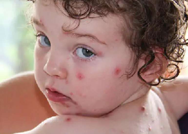 टोमैटो फ्लू क्या है? कारण, लक्षण और उपचार | Tomato Flu in Hindi