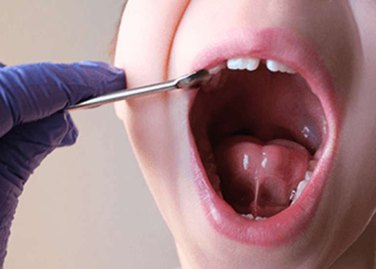 फ्रेनेक्टोमी क्या है? | Frenectomy in Hindi