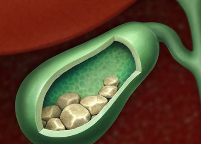 पित्त की पथरी एक गंभीर समस्या | Gallstones in Hindi