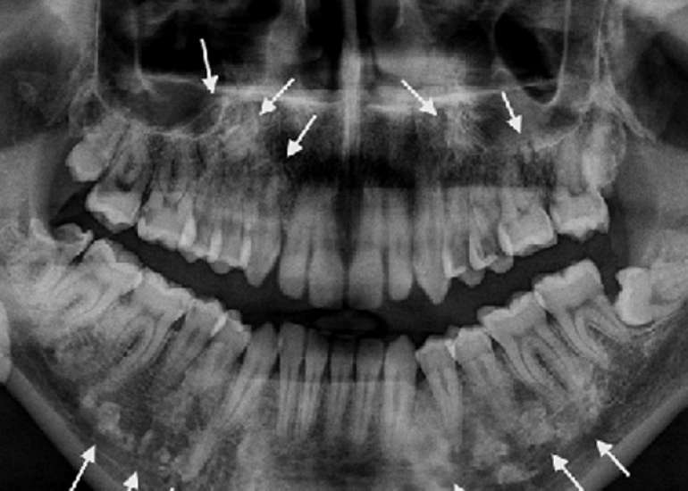 गार्डनर सिंड्रोम क्या है? कारण, लक्षण और इलाज | Gardner Syndrome in Hindi