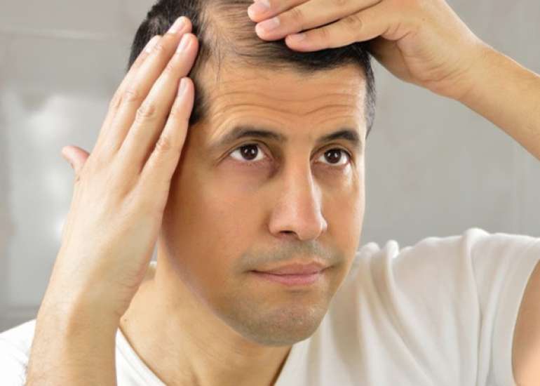 Hair Loss : Causes, Treatment & Prevention