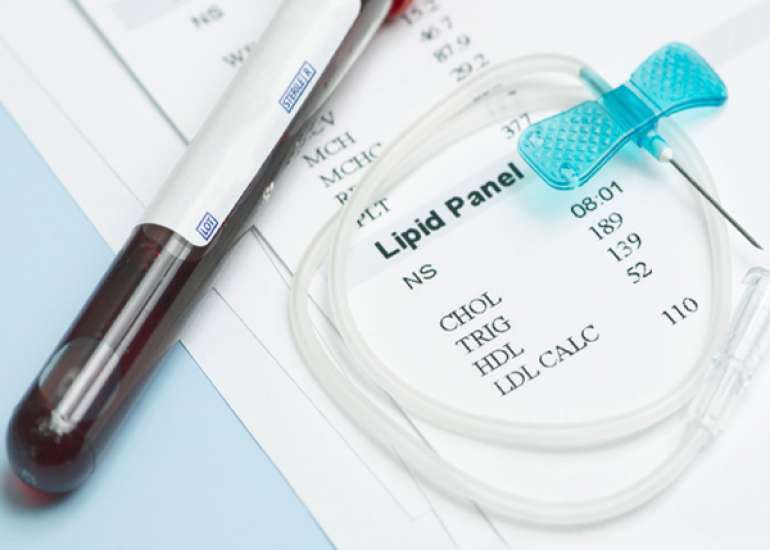 How do we do the LDL cholesterol test?
