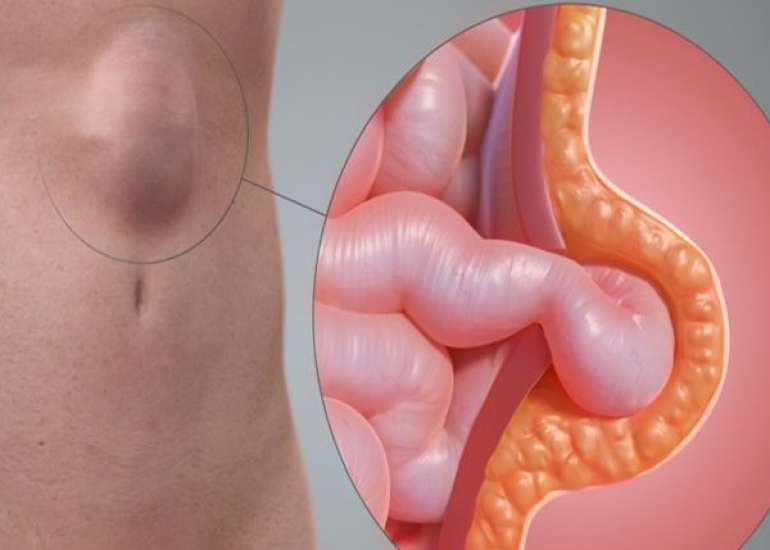 हर्निया क्या है? लक्षण, कारण, प्रकार और इलाज | Hernia in Hindi