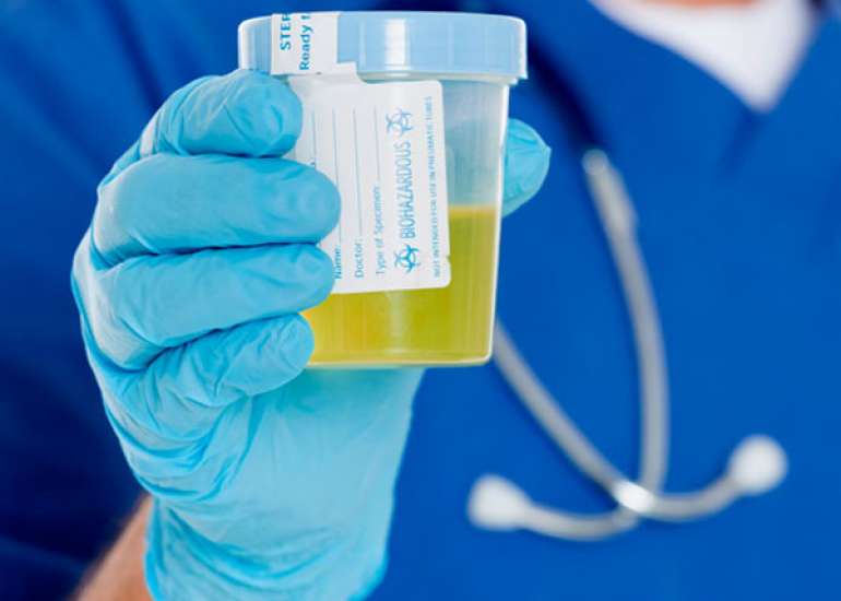 How reliable is urine sugar test?