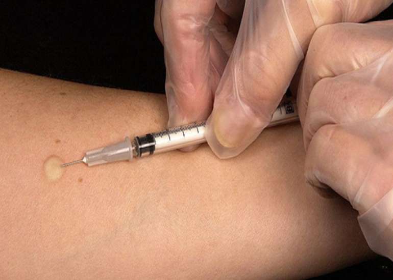 What is  an Intradermal Injection Procedure?