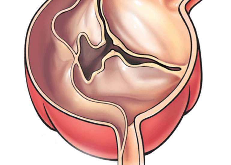 How should we diagnose dissection of aorta?