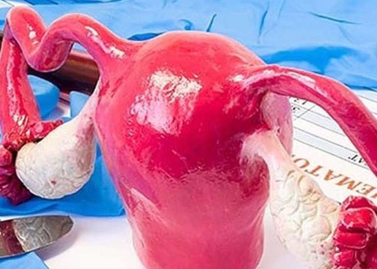 हिस्टेरेक्टॉमी क्या है | Hysterectomy in Hindi 