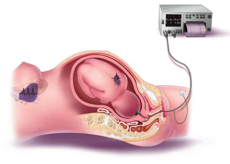iPREFACE score for predicting fetal acidemia by intrapartum fetal heart rate monitoring