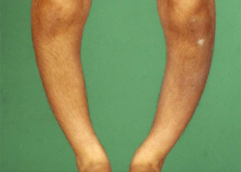 रिकेट्स यानि सूखा रोग कितना गंभीर? कारण, लक्षण, इलाज और बचाव | Rickets in Hindi