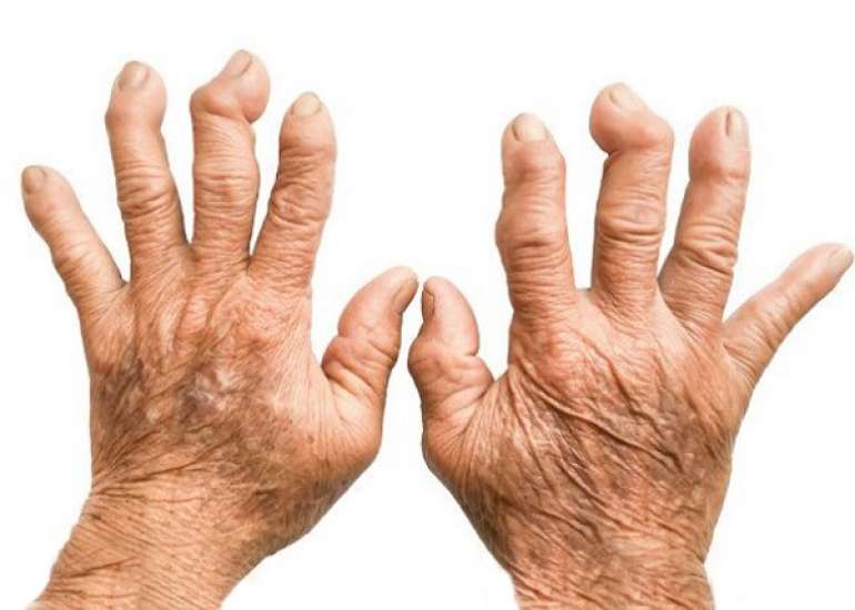 सोरियाटिक गठिया के बारे में सब जाने | Psoriatic Arthritis in Hindi