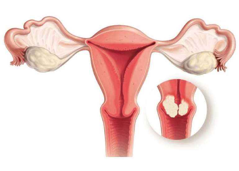 नाबोथियन सिस्ट क्या है? कारण, लक्षण, जोखिम कारक और उपचार | Nabothian Cyst in Hindi