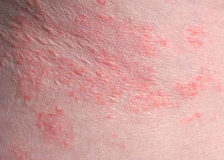 इंटरट्रिगो क्या है? कारण, लक्षण और इलाज | Intertrigo in Hindi