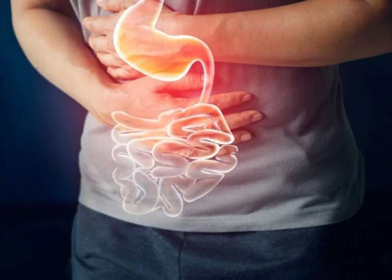 Irritable Bowel Syndrome (IBS): A Common Gastrointestinal Disorder
