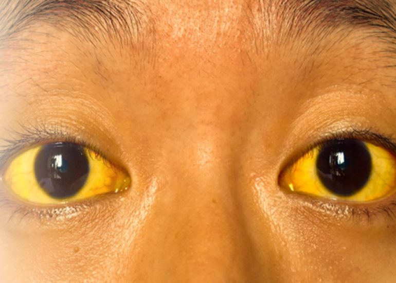 पीलिया और लीवर स्वास्थ्य: एसजीपीटी और एसजीओटी स्तरों का महत्व