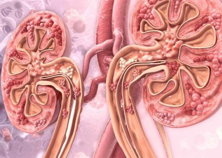 फैंकोनी सिंड्रोम क्या है? लक्षण, कारण और इलाज | Fanconi Syndrome in Hindi