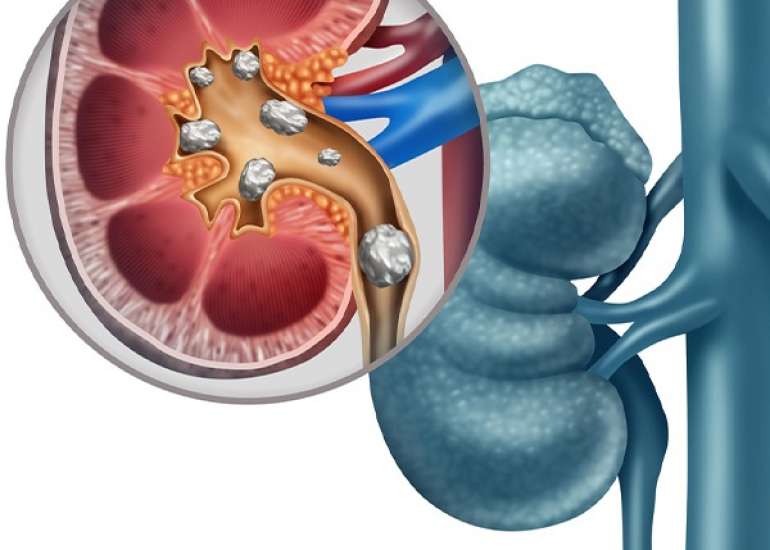 किडनी स्टोन या गुर्दे में पथरी, प्रकार, लक्षण, कारण और उपचार | Medtalks