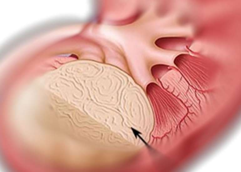 किडनी (गुर्दे) का कैंसर - किडनी का कैंसर क्यों होता है, लक्षण, उपचार, दवा