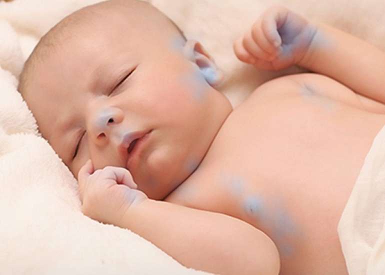 ब्लू बेबी सिंड्रोम – लक्षण, कारण और उपचार | Blue Baby Syndrome In Hindi