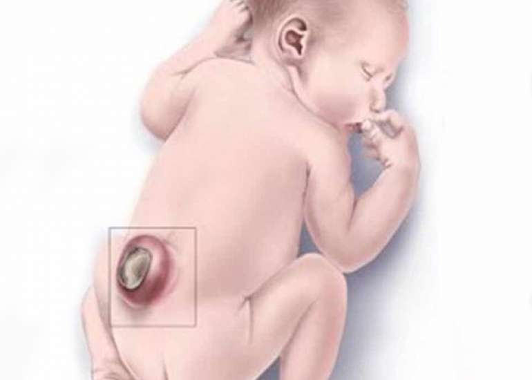 स्पाइना बिफिडा क्या है | Spina Bifida in Hindi