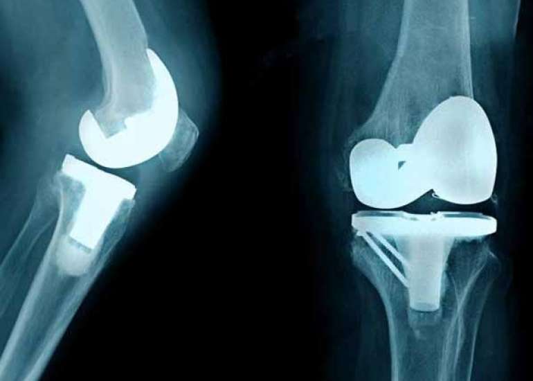 Unilateral vs bilateral knee replacement?
