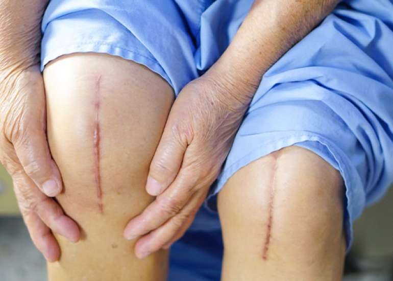 घुटने बदलने का ऑपरेशन या नी रिप्लेसमेंट सर्जरी के बारे में सब जाने | Knee Replacement in Hindi