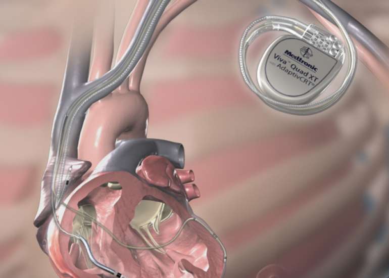 What is the difference between one lead, two lead and three lead pacemakers?