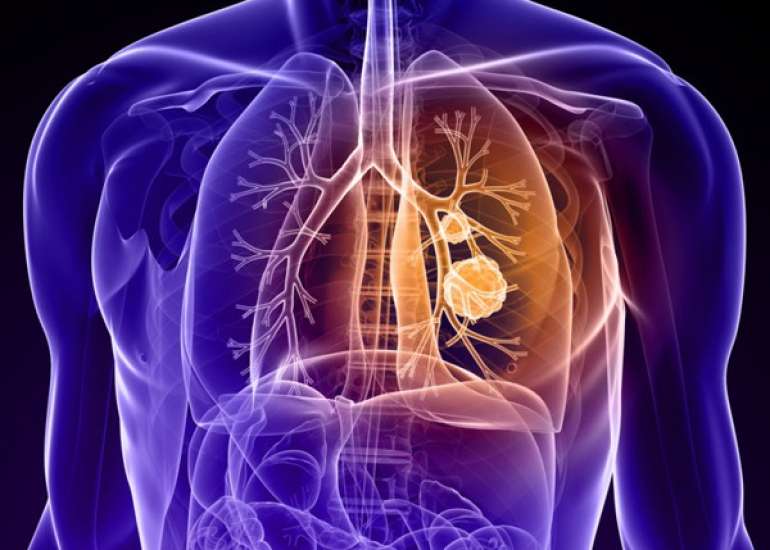 सिस्टिक फाइब्रोसिस रोग कितना गंभीर है? लक्षण, कारण और इलाज सब जाने | Cystic Fibrosis in Hindi
