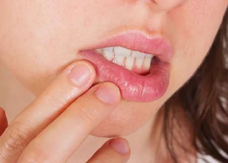 होंठ का कैंसर क्या है? कारण, लक्षण और इलाज| Lip Cancer in Hindi