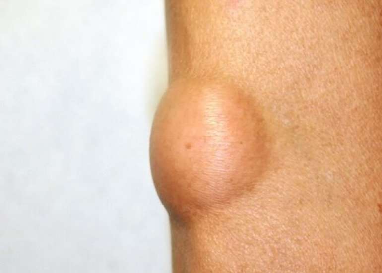 लिपोमा क्या है? कारण, लक्षण और इलाज | Lipoma in Hindi