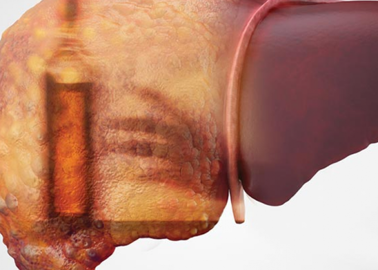 Liver Failure: Causes, Symptoms, and Treatment