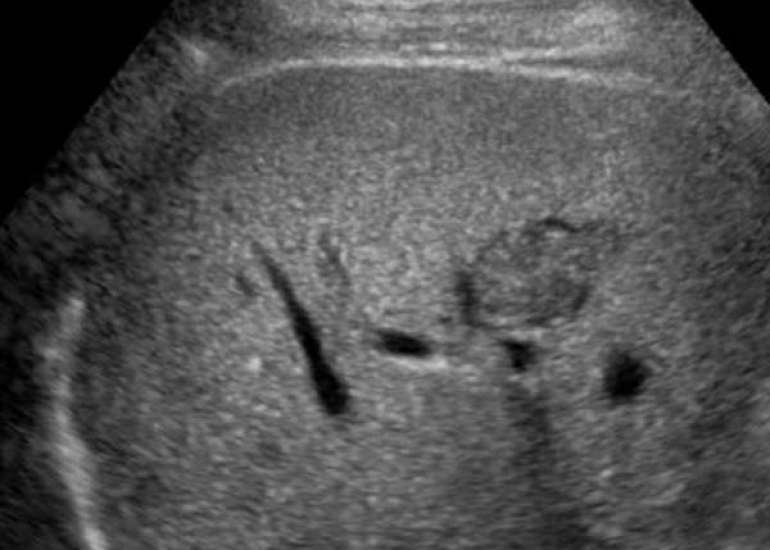 Liver Lesions: Types, Diagnosis, and Management