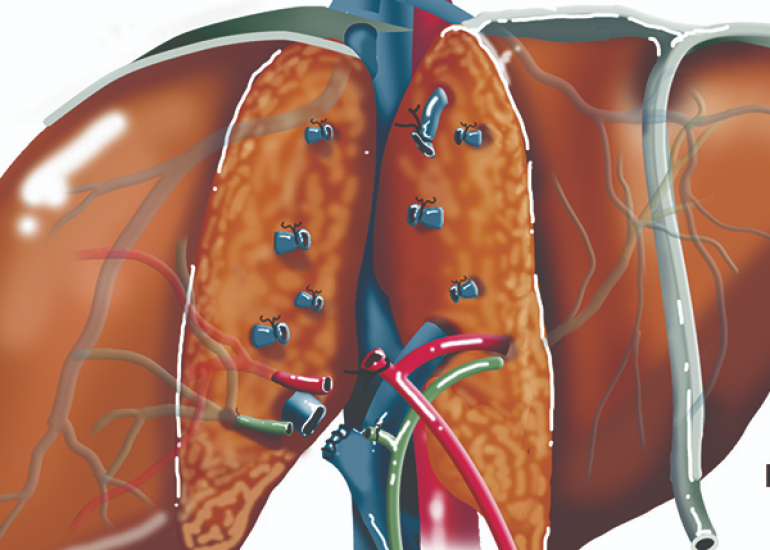 Liver Transplantation: Procedure, Eligibility, and Postoperative Care