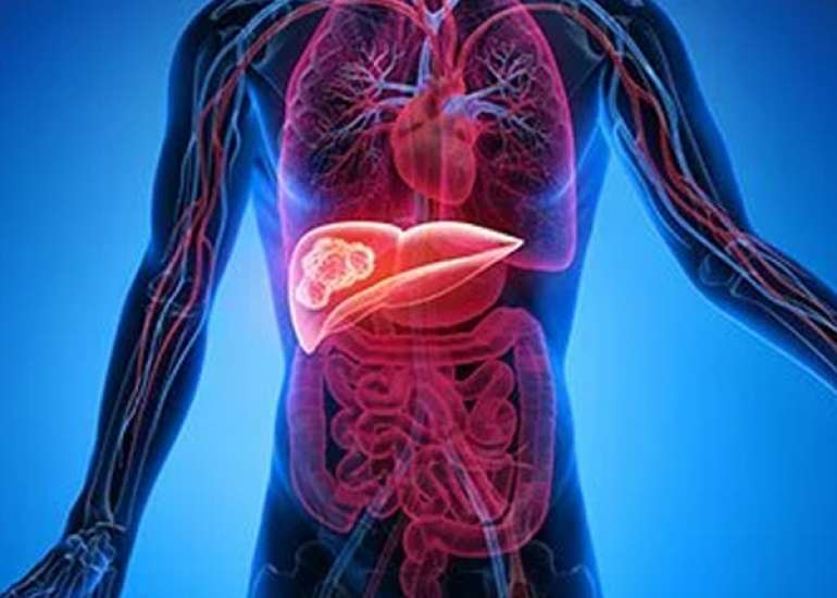 लिवर कैंसर के लक्षण और इलाज 