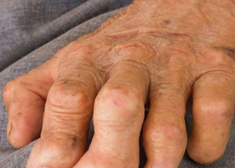 कुष्ठ रोग - एक ईश्वरीय प्रकोप या बीमारी ? विस्तार से जाने  